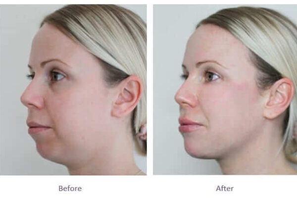 Jawline Filler