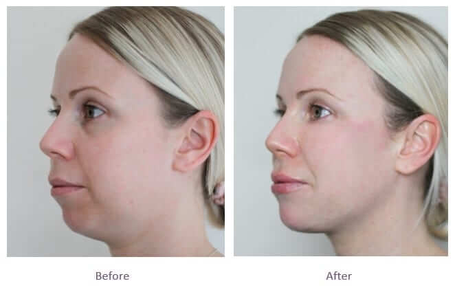 Jawline Filler