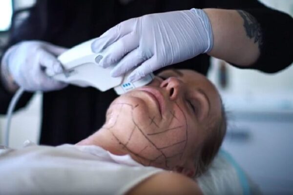 Ultherapy