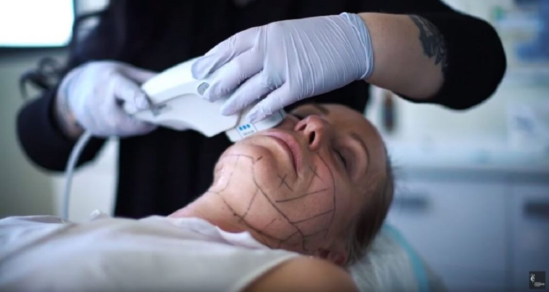 Ultherapy